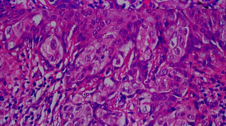 Extramammary Paget's Disease