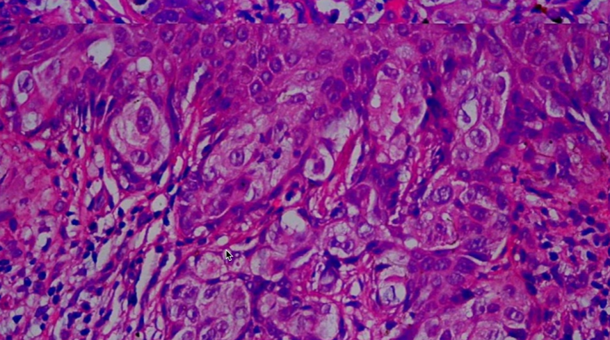 Extramammary Paget's Disease Extramammary Paget's Disease